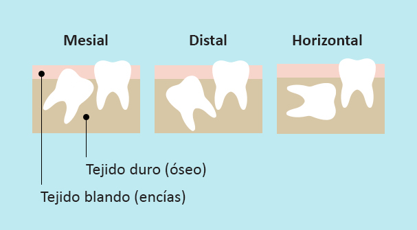 La retención mesial es cuando el diente sale en un ángulo que se dirige hacia otros dientes, mientras que la distal significa que sale en ángulo contrario respecto de los otros dientes. La retención horizontal es cuando los dientes crecen de costado. La retención de los dientes puede ocurrir en el tejido duro (óseo) o en el tejido blando (encías).